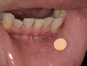 口 の 中 白い 膜