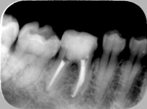 歯の神経の治療はなぜ何回もかかるのか 実は90 が3回以内に終わる