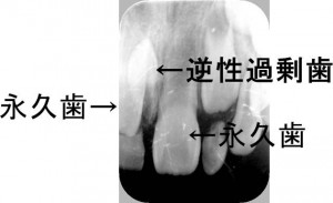 逆性過剰歯