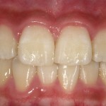 ダイレクトボンディングは前歯のすきっ歯や虫歯を1日で治す治療法