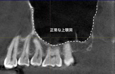 虫歯じゃないのに歯が痛い上顎洞炎で起こる8つの症状と最適な治療法