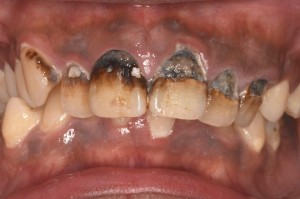 キレイに治す前歯の虫歯治療 笑顔をとりもどす治療
