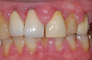 10代から始まる／歯茎が赤く腫れているのは歯肉炎の症状
