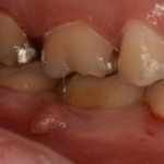 歯茎にできた白いできものの正体と治療法