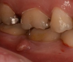 歯茎にできた白いできものの正体と治療法