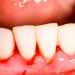 歯周病の症状／そのままではいけない歯茎の出血と１３の症状