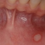 痛い口内炎！歯茎の痛みを３日で取る治し方ー５つのステップ