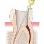 歯の根の先に膿が溜まる歯根嚢胞／８つの症状と治療法