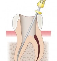 歯の根の先に膿が溜まる歯根嚢胞 ８つの症状と治療法