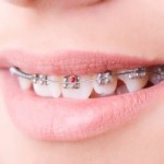 歯科矯正の痛みについて知っておきたい４項目