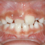 前歯の歯並びが悪いことで起こる６つのこと／きれいに治す治療法