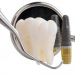 インプラント治療で残っている前歯を削らない！ブリッジより優れている５つのこと