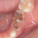 虫歯ができる7つの原因と自分にあった予防法