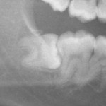 親知らずの虫歯｜治療か抜歯の判断基準を解説