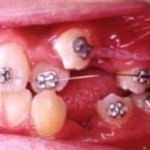 あなたの八重歯はこうして治る／写真でわかる矯正治療