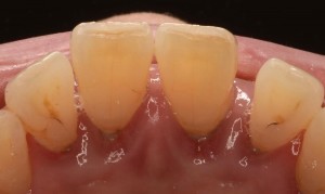 危険 黒い歯石は歯茎の出血からできている