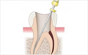 歯の寿命はこれで決まる！歯の根の治療の根管治療と全情報を大公開