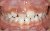 前歯の歯並びが悪いことで起こる６つのこと／きれいに治す治療法