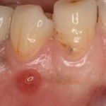 歯茎にできたおでき／フィステルの原因と治療法