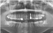 親知らずの虫歯 | 治療か抜歯の判断基準を解説