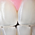 虫歯予防の最前線／歯のエナメル質を再生し、強化する方法