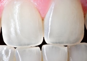 歯の傷が着色の原因 アパガードリナメルの３つの効果と使用法