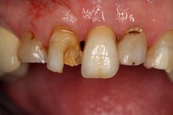膜 炎 歯根 非感染の歯根膜炎で４ヶ月以上たっても痛む
