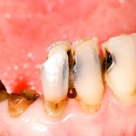 虫歯が増える！唾液が少ないことによって起こる９つの危険