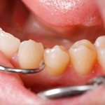 歯槽骨が吸収する原因と予防法・再生させる方法
