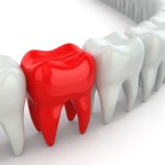 歯周病で溶けた骨を治療するエムドゲイン再生療法とは！