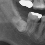 親知らず抜歯の費用／まっすぐ･横向き･埋まっている手術の料金と手順