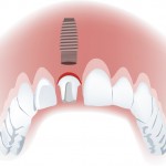 インプラントの全情報と全知識のまとめ／インプラント治療が残っている歯の寿命を延ばす