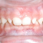 笑うと歯茎が見える！ガミースマイルの３つの治療法と費用