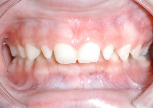 笑うと歯茎が見える ガミースマイルの３つの治療法と費用