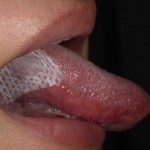 舌が痛い！舌にできた口内炎をすぐに治す５つ方法と舌癌との見分け方