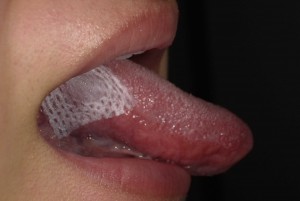 舌が痛い 舌にできた口内炎をすぐに治す５つ方法と舌癌との見分け方