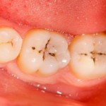 削らない歯医者がやっている虫歯を残しても進行しない７つの方法