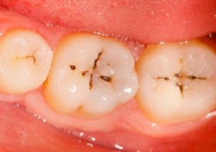 虫歯 麦茶 麦茶は虫歯の予防になるって本当？それとも悪影響？