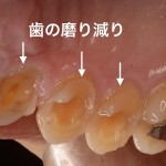 歯ぎしりを引き起こす５つの原因と対処法／症状と治療法