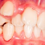 八重歯とは！八重歯になる原因と治療法／付け八重歯の方法