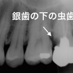 差し歯や銀歯が臭くなる７つの原因と治療法／放置すると抜歯の危険