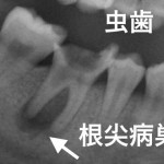 歯根の膿／根尖病巣（こんせんびょうそう）の８つの症状と治療法