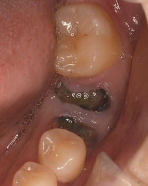 痛みはないが絶対放置してはいけない危険な５つの虫歯と治療