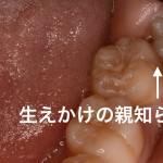 親知らずが生えかけで歯茎が痛い時、すぐに痛みを取る６つの方法
