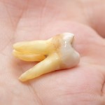 歯が揺れる！歯がグラグラしてきた時の５つの原因と治療法