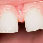 前歯だけを矯正する部分矯正／短期間で治す５つの方法と費用