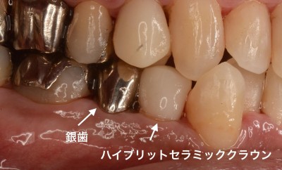 もの 歯 値段 かぶせ 保険で出来る奥歯の白いかぶせもの、ＣＡＤ/ＣＡＭ(キャドキャム)冠について