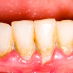 やさしい歯周病、歯槽膿漏の治し方／４つのステップ