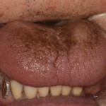 舌が黒い！黒毛舌（こくもうぜつ）の原因と改善方法