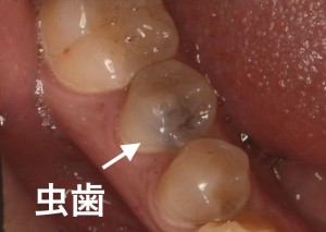 奥歯が臭い 奥歯の歯や歯茎が臭くなる１２の原因と対処法